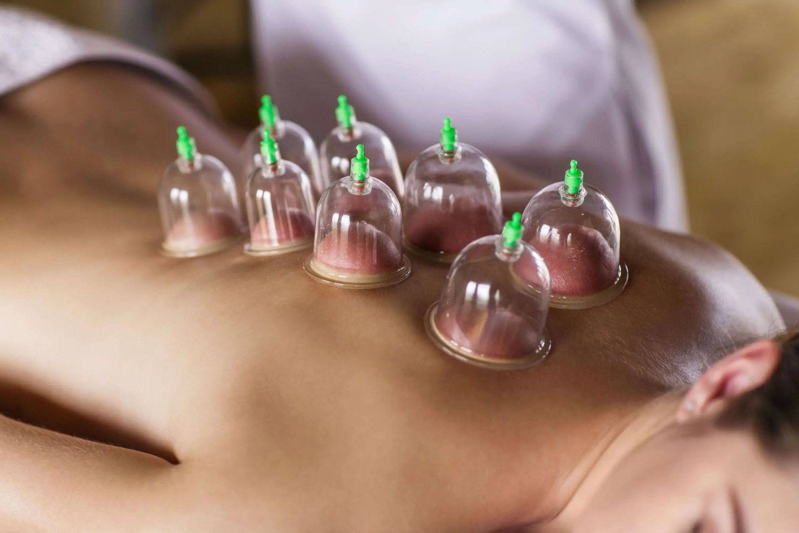 Cupping Therapy